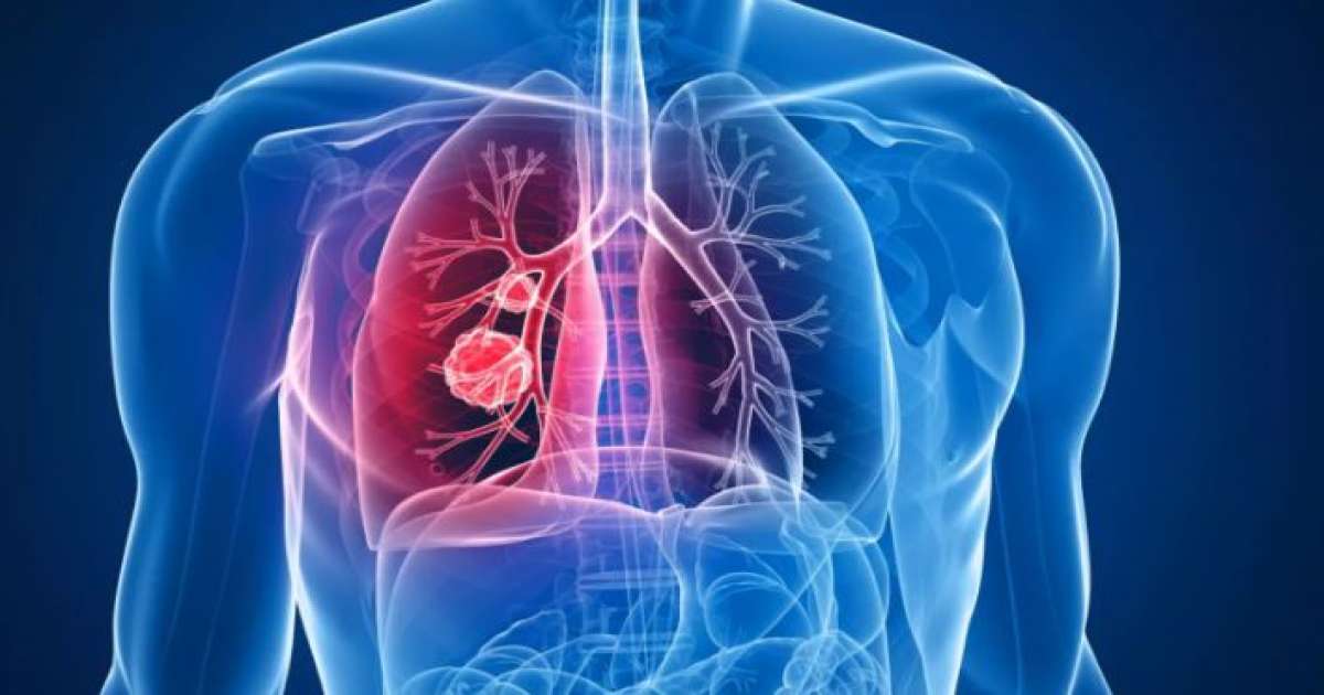 سنويا: 3000 حالة إصابة بسرطان الرئة في تونس